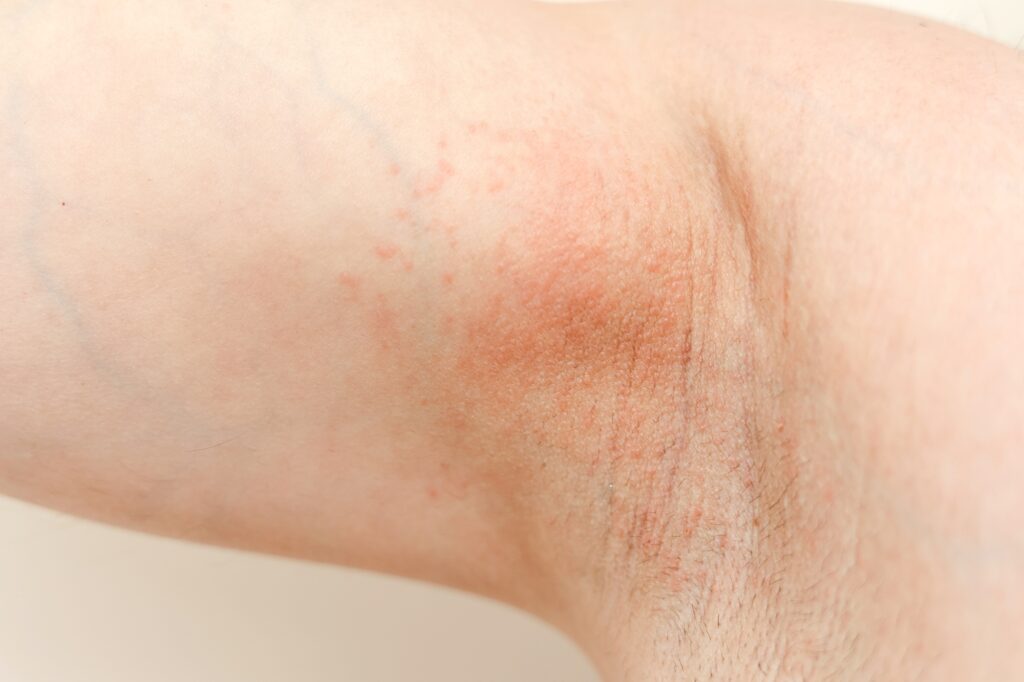 Allergy underarm. Cropped photo of irritation, inflammation on the sensitive skin after using a razo