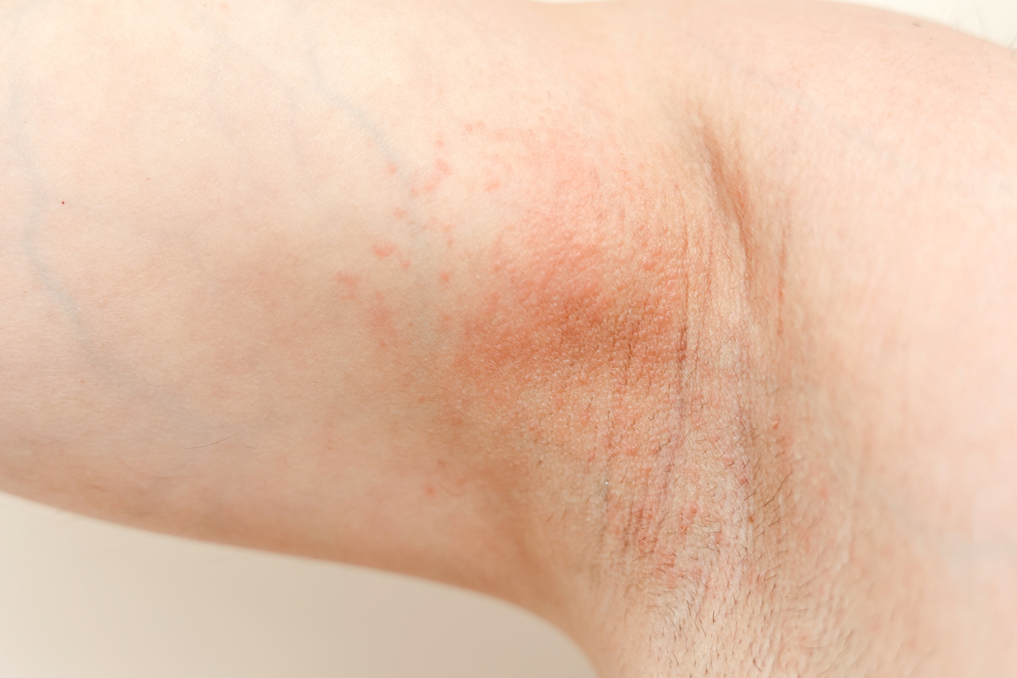 Allergy underarm. Cropped photo of irritation, inflammation on the sensitive skin after using a razo